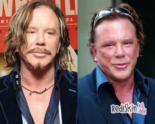 Знаменитости, утратившие свою красоту из-за пластики