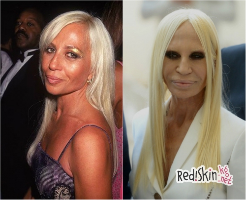 Знаменитости, утратившие свою красоту из-за пластики