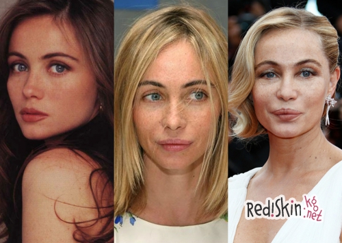 Знаменитости, утратившие свою красоту из-за пластики