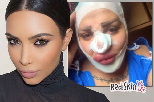 Одержимый пластической хирургией и семейством Кардашьян-Дженнер: 24-летний Джордан сделал нос как у Ким, а подбородок как у Кайли (видео)