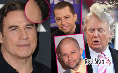 Знаменитости, которые прошли процедуру по трансплантации волос