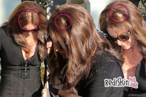 Знаменитости, которые прошли процедуру по трансплантации волос