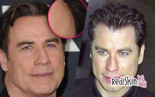 Знаменитости, которые прошли процедуру по трансплантации волос