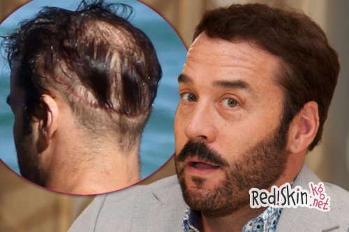 Знаменитости, которые прошли процедуру по трансплантации волос