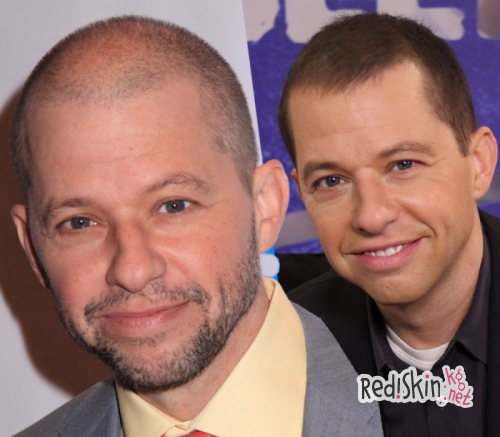 Знаменитости, которые прошли процедуру по трансплантации волос