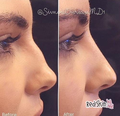 Бритни Уорд сделала пластику носа