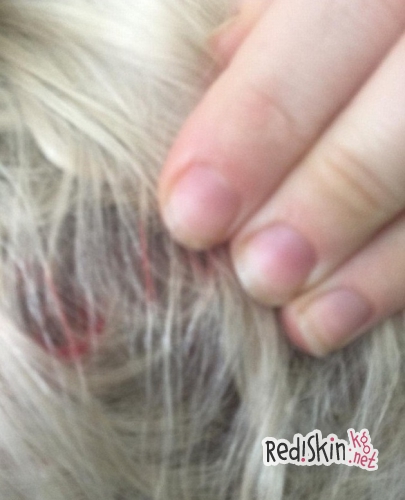 Майли Сайрус показала исцарапанное лицо, руку и голову